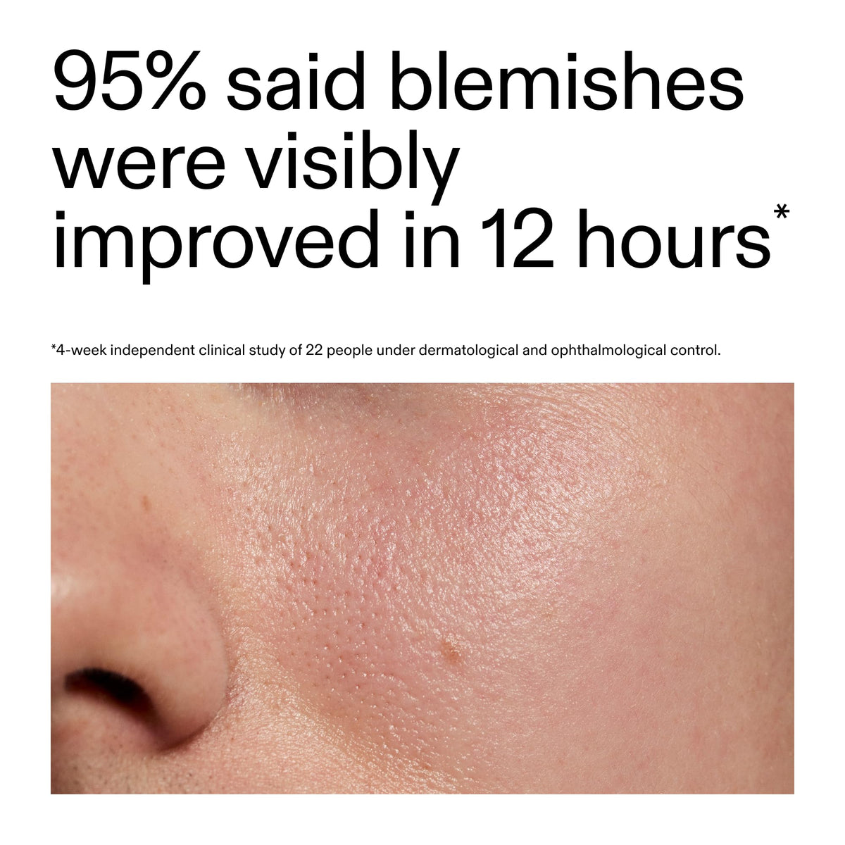 The INKEY List Succinic Acid Treatment applied directly to a blemish to shrink it