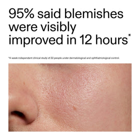 The INKEY List Succinic Acid Treatment applied directly to a blemish to shrink it
