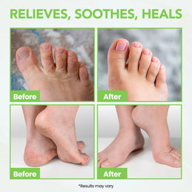 Thena Foot Care Ointment showing texture on dry cracked heels for moisture.