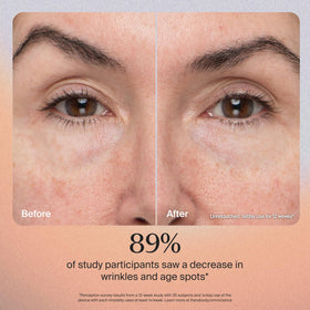 TheraFace Pro light therapy for skin tightening and improved texture.