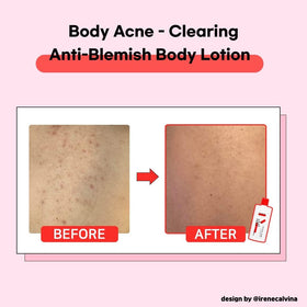 TIAM Anti-Blemish Body Lotion milky texture absorbs quickly for a comfortable finish.