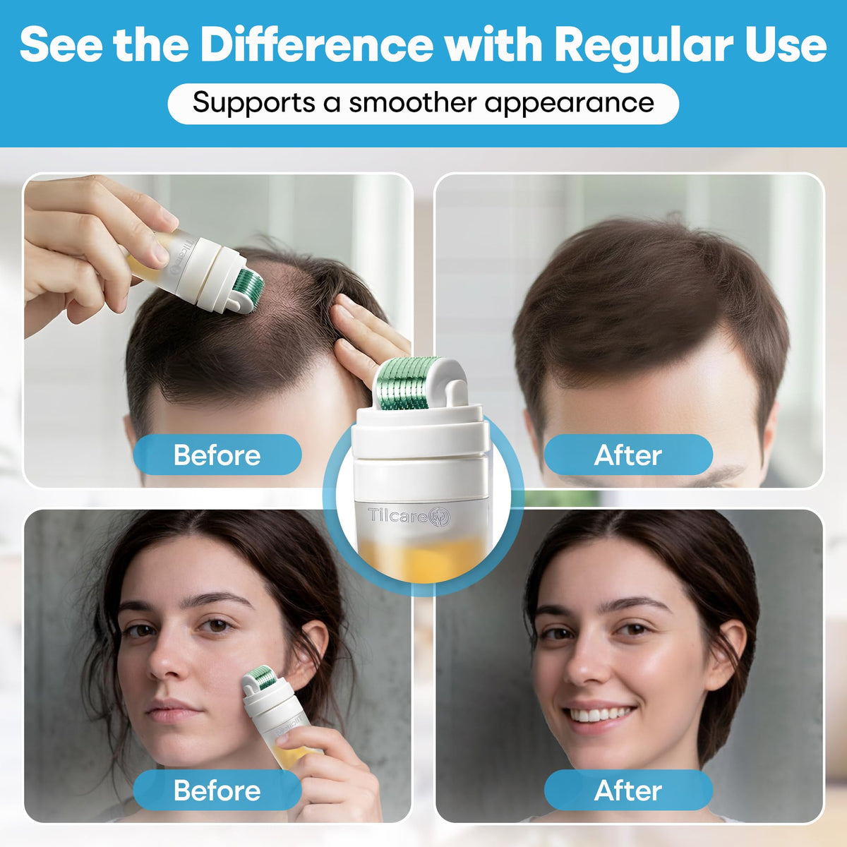 Tilcare Derma Roller for beard use in grooming routine.