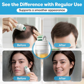 Tilcare Derma Roller for beard use in grooming routine.