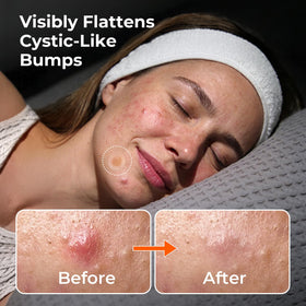 TKTK 265 hydrocolloid patch adheres gently to skin.