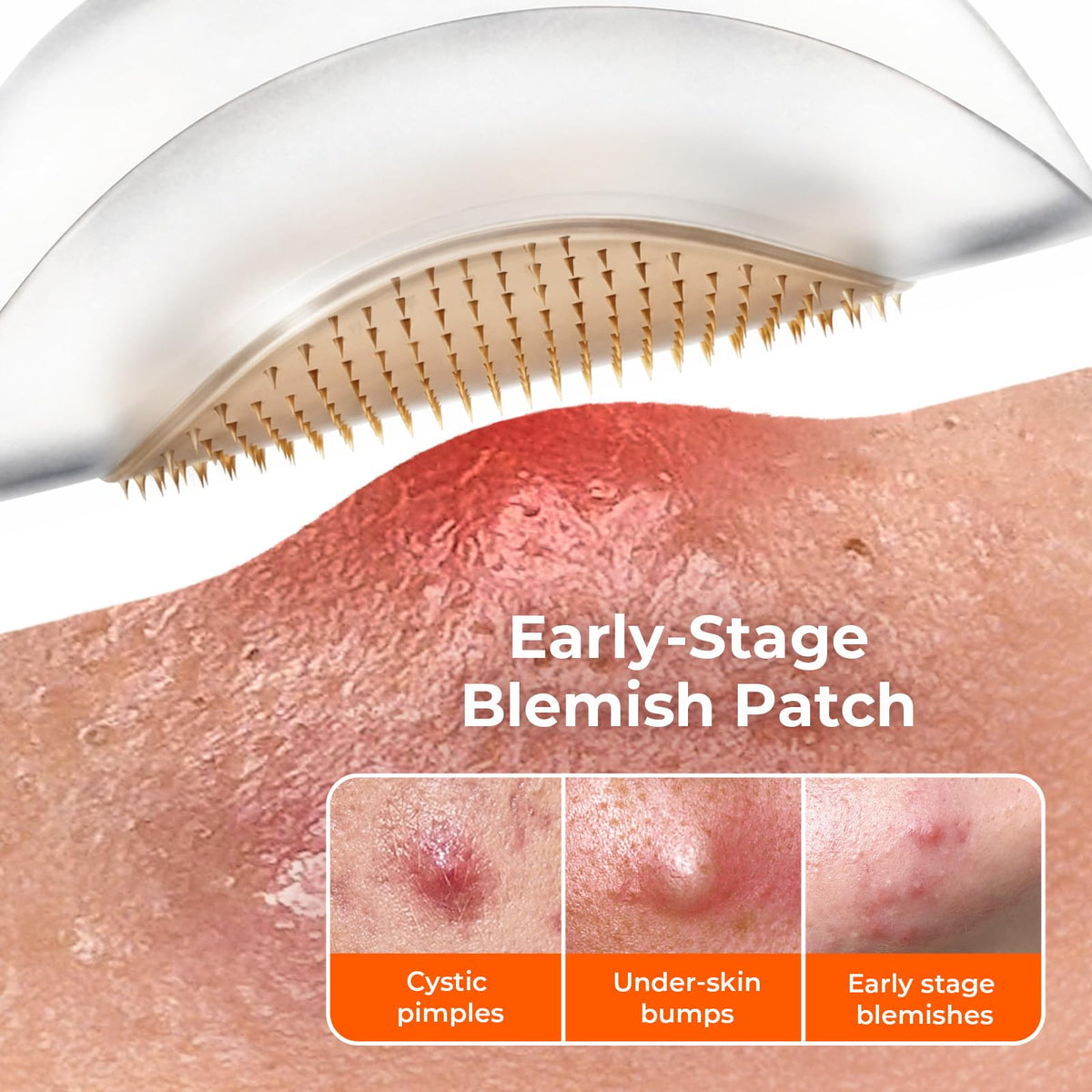 TKTK 265 patch on pimple for overnight use to support appearance.