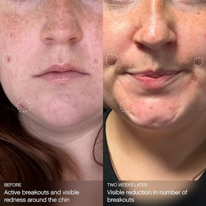 Hypochlorous acid visual cue purifies pores and soothes redness.