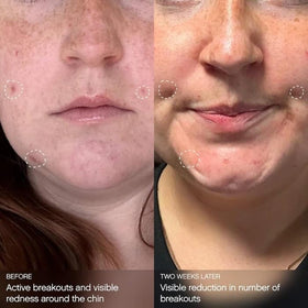 Hypochlorous acid visual cue purifies pores and soothes redness.