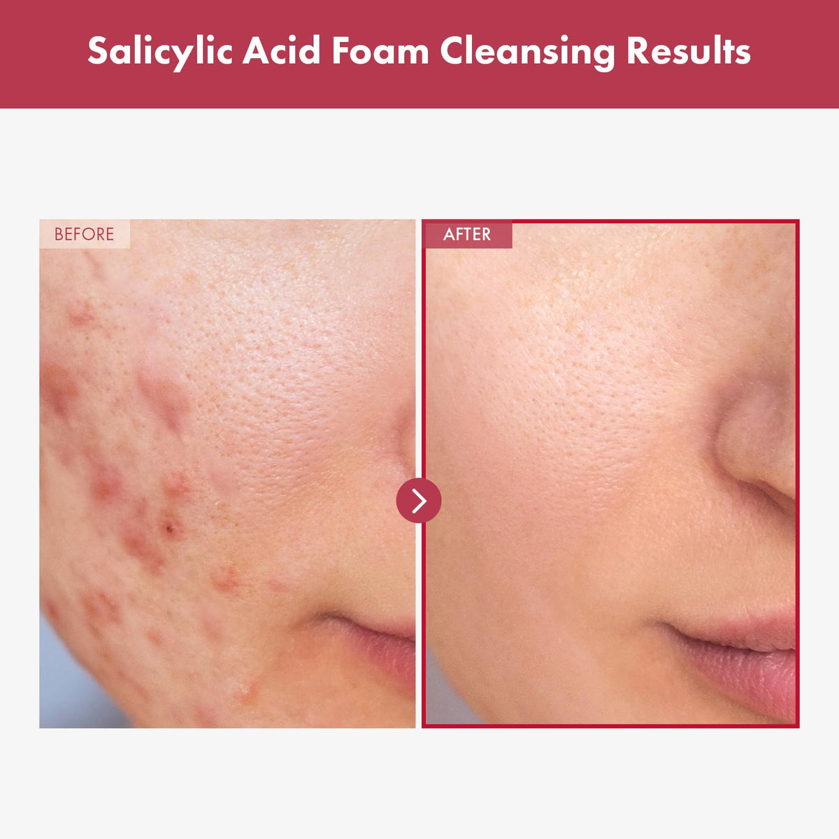 TOSOWOONG Salicylic Acid Foam Cleanser rich foam texture on skin for gentle exfoliation