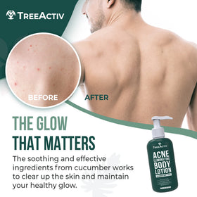 TreeActiv Acne Eliminating Body Lotion back view shows lightweight, fast-absorbing formula
