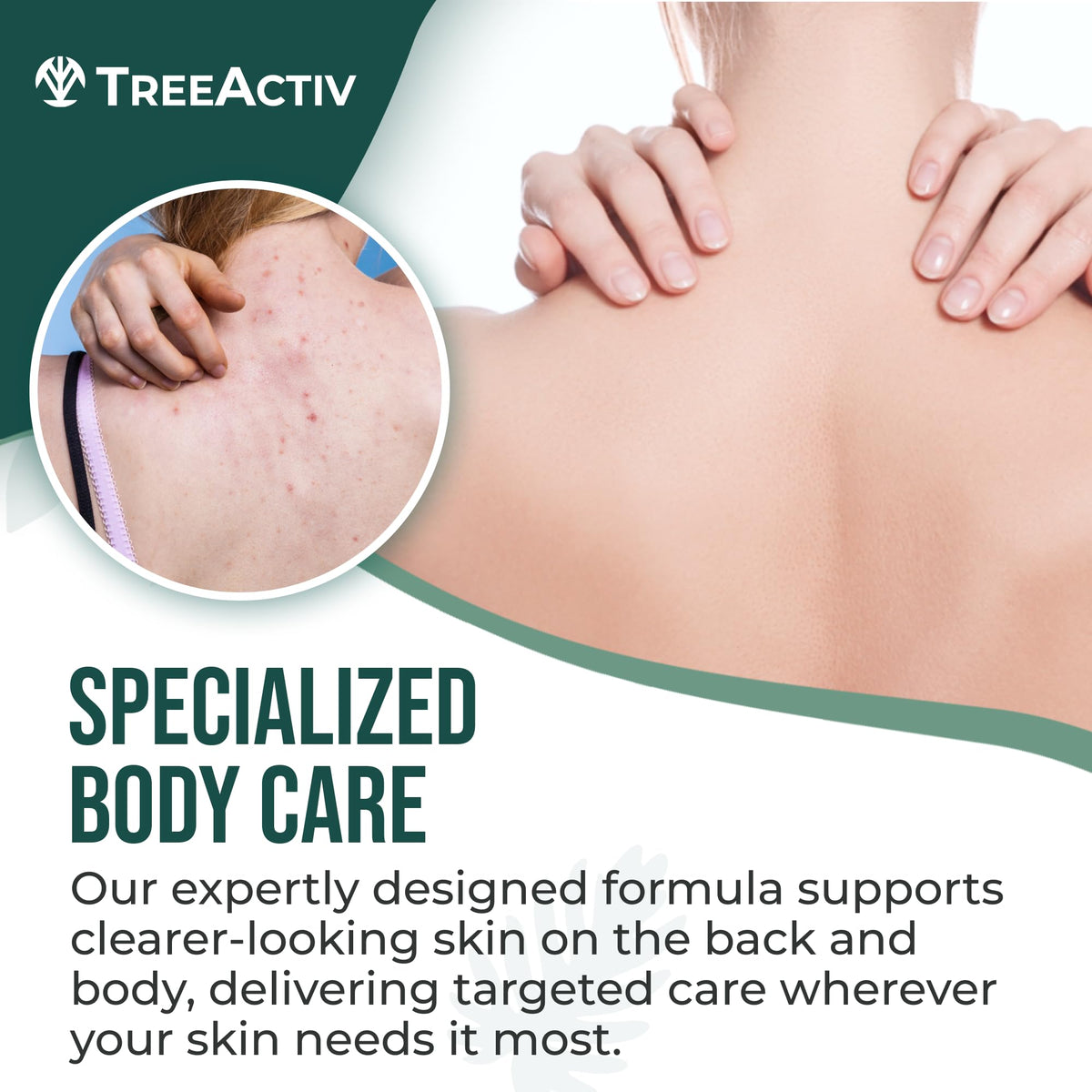 TreeActiv body acne spray application showing quick, even treatment on skin.
