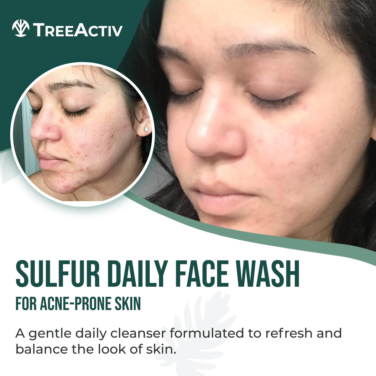 TreeActiv foaming face wash lather demonstrates gentle cleansing for balanced skin.