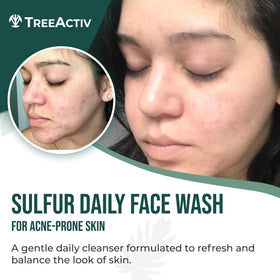 TreeActiv foaming face wash lather demonstrates gentle cleansing for balanced skin.