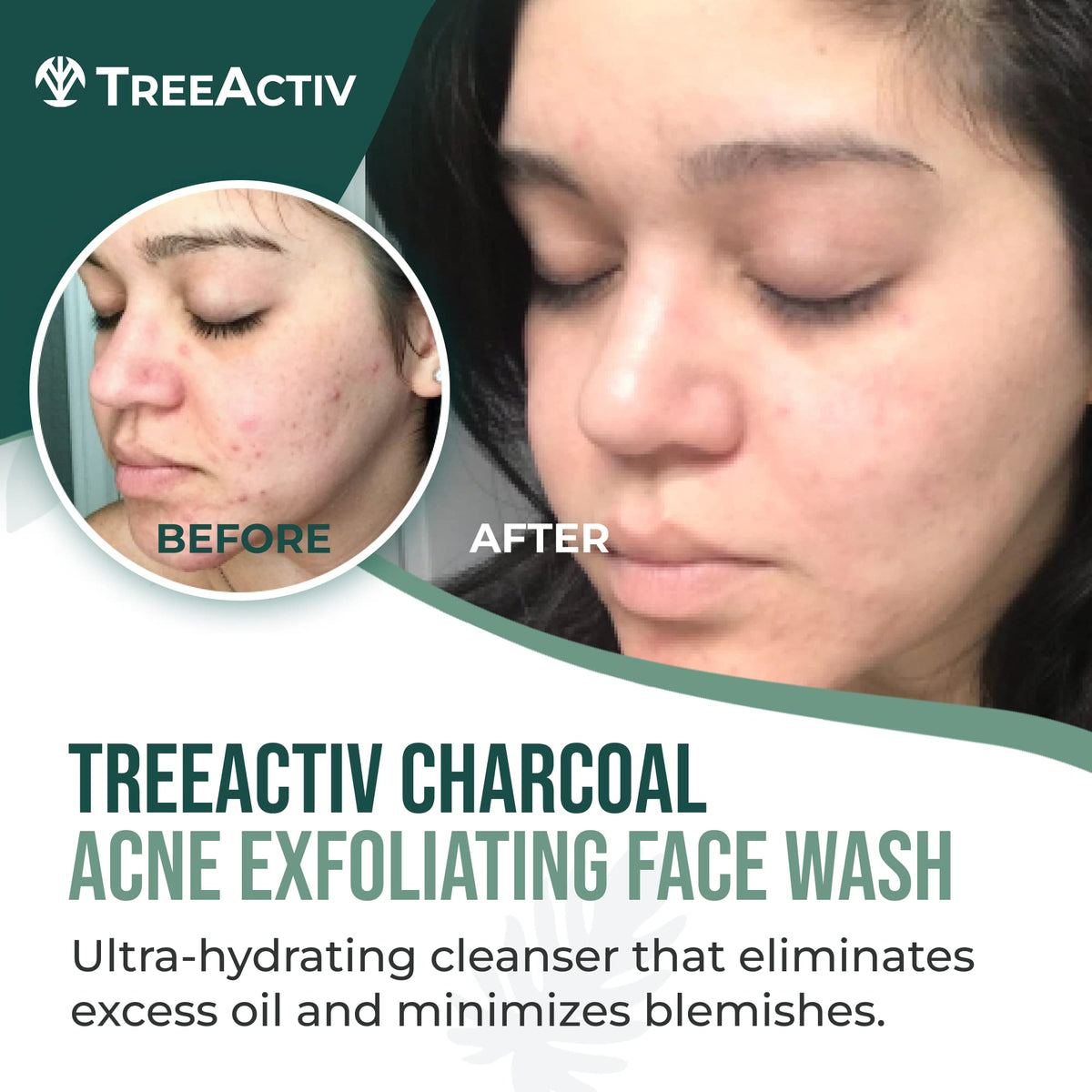 TreeActiv honey sulfur ingredients close-up highlight sebum balance and cleansing