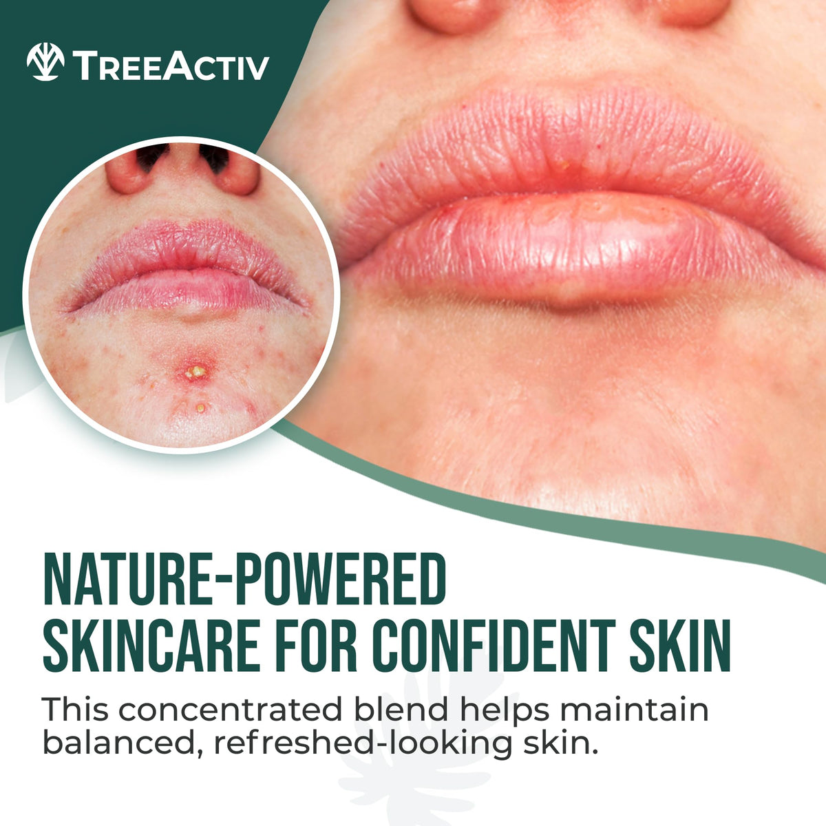 Overnight TreeActiv cream texture ready for gentle cystic acne care.