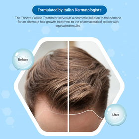Tricovit Forte ampoules applied to the scalp for targeted nourishment.