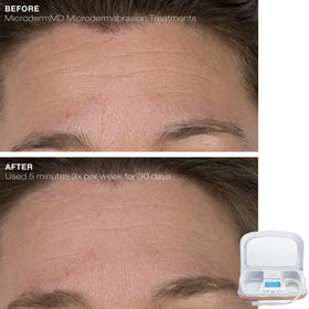 Trophy Skin MicrodermMD anti-aging focus with diamond tip improving texture