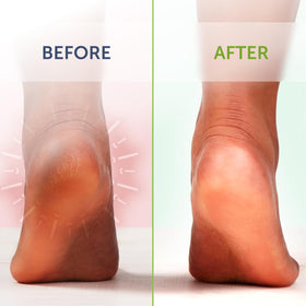 Truremedy Naturals at-home foot care routine after workouts or busy days.