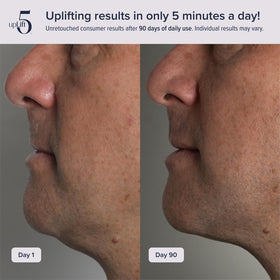 upLift 5 face and neck toning result emphasizing improved contours