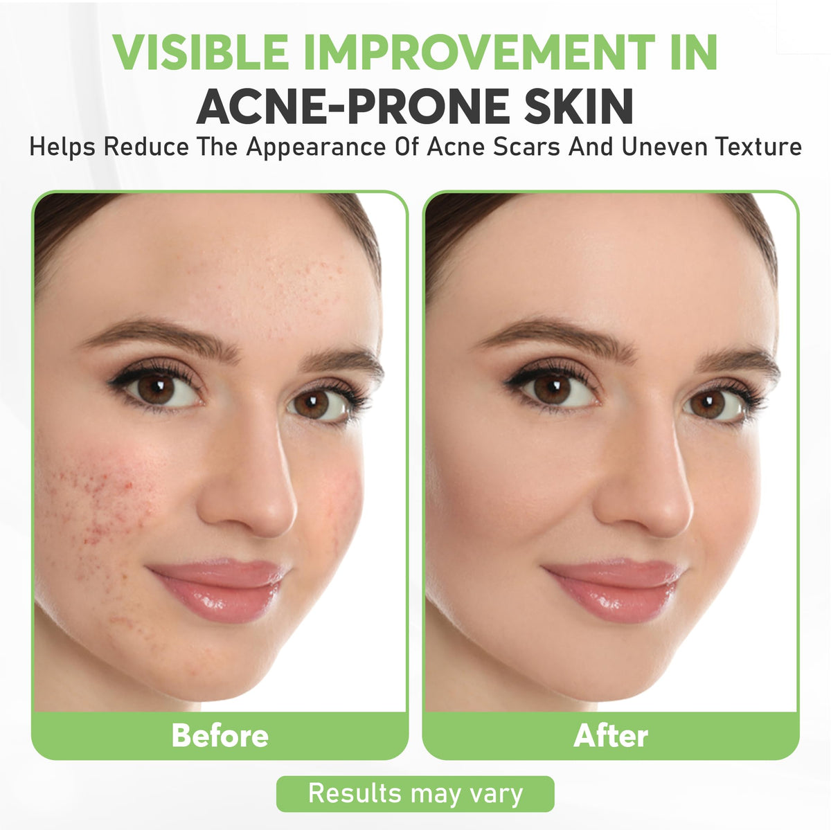 Varixoa serum dropper close-up showing precise application for blemish-prone skin