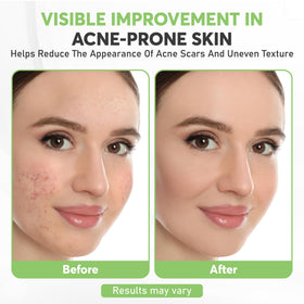 Varixoa serum dropper close-up showing precise application for blemish-prone skin