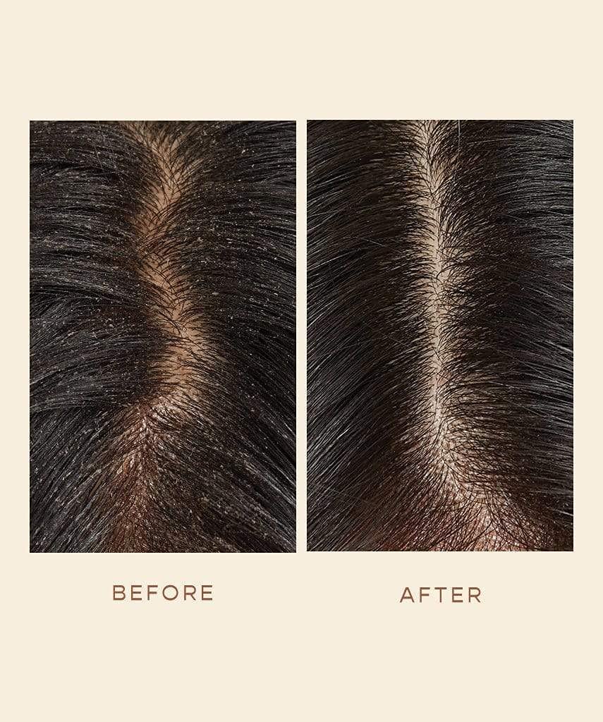 Willowherb extract as a key ingredient for scalp balance.