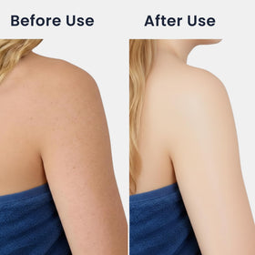 Vertaze back scrubber showing hex pattern for dual exfoliation of oil and dead skin.