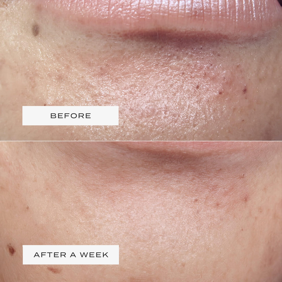 Vue Chin Patches offer a gentle, irritation-free fit that stays put while sleeping.