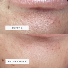 Vue Chin Patches offer a gentle, irritation-free fit that stays put while sleeping.