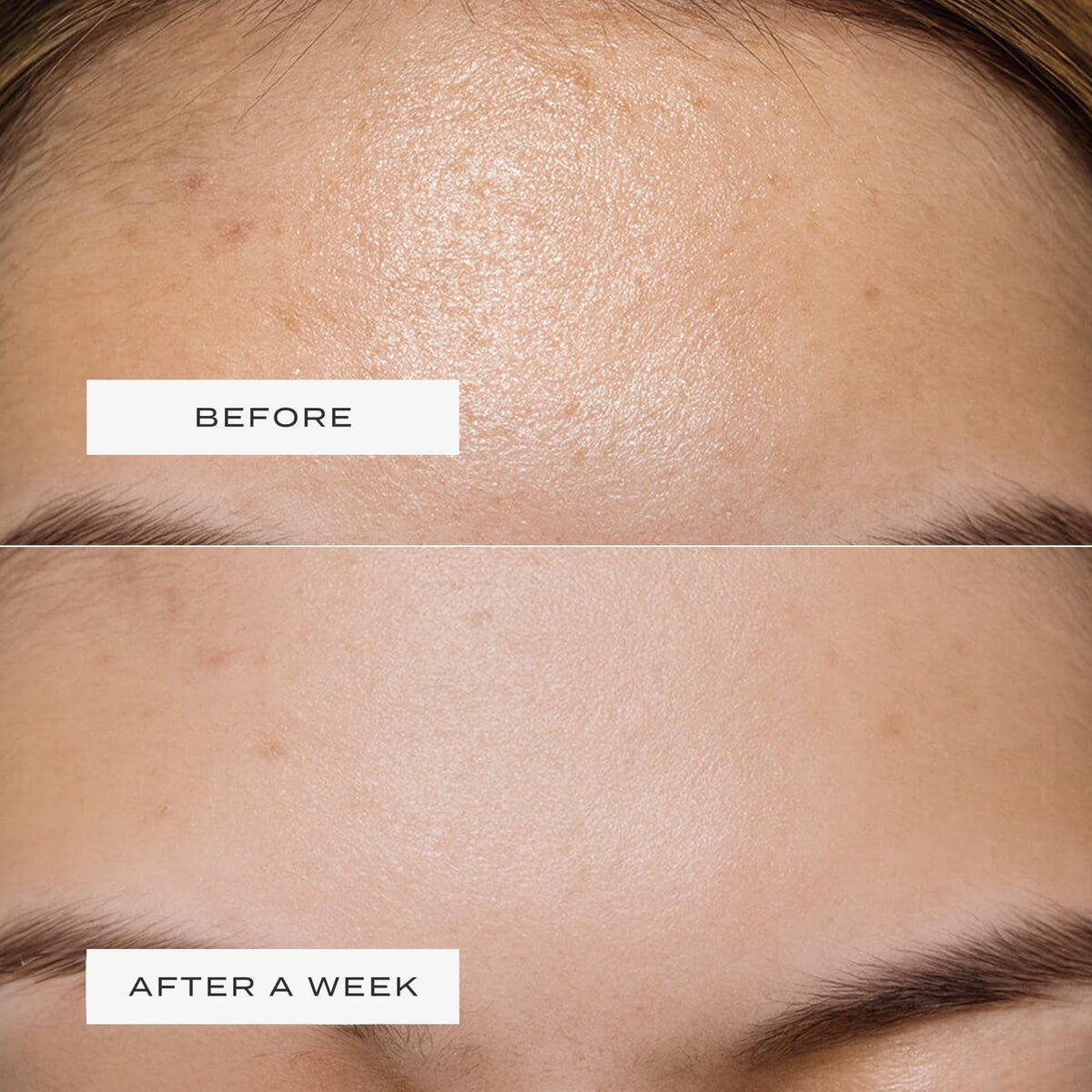 Vue Forehead Patches flexible design stays in place without irritation.