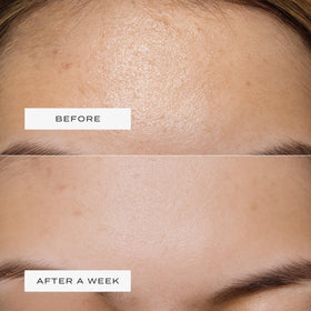 Vue Forehead Patches flexible design stays in place without irritation.