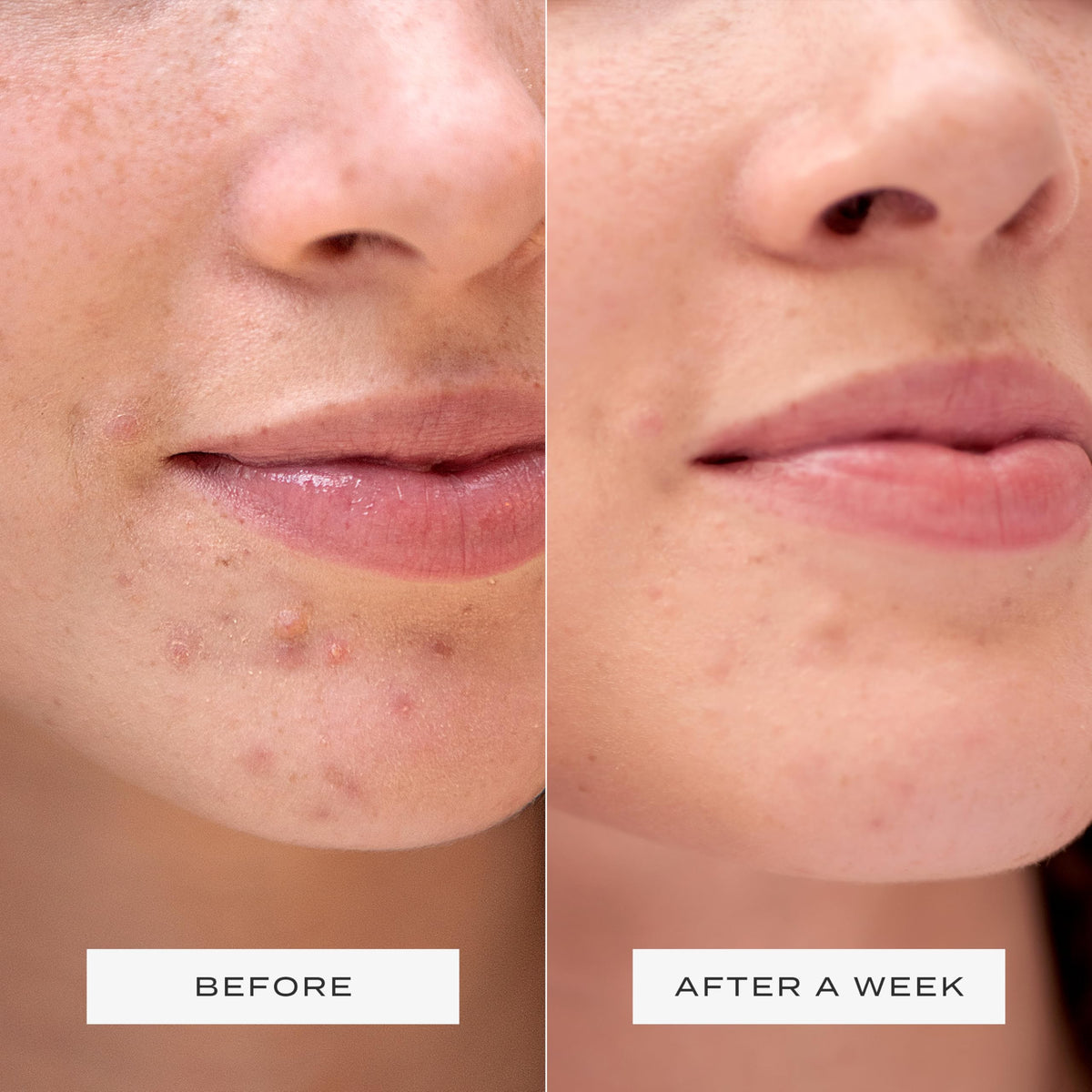 Vue Surface Clearing Patches soft-material sits gently and comfortably on skin.
