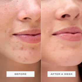 Vue Surface Clearing Patches soft-material sits gently and comfortably on skin.
