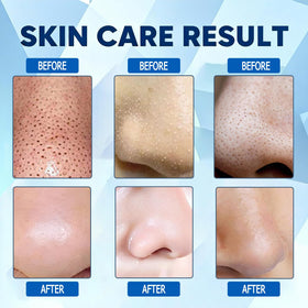 Vue Swiss nose patches pore-clearing close-up for smoother texture