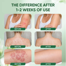 Under-breast application of WNOHIQ Intertrigo Relief Cream for comfort.