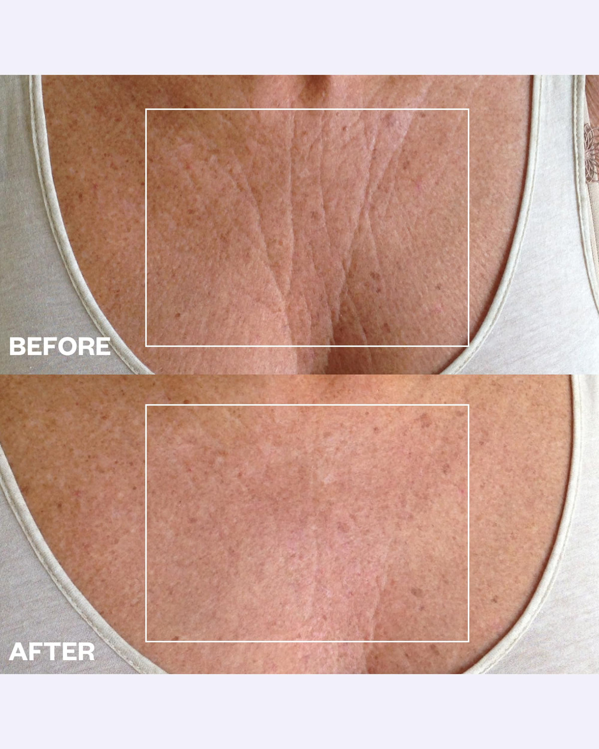 Wrinkles Schminkles body patches on skin for smoothing and texture improvement.