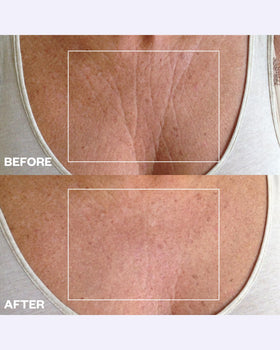 Wrinkles Schminkles body patches on skin for smoothing and texture improvement.