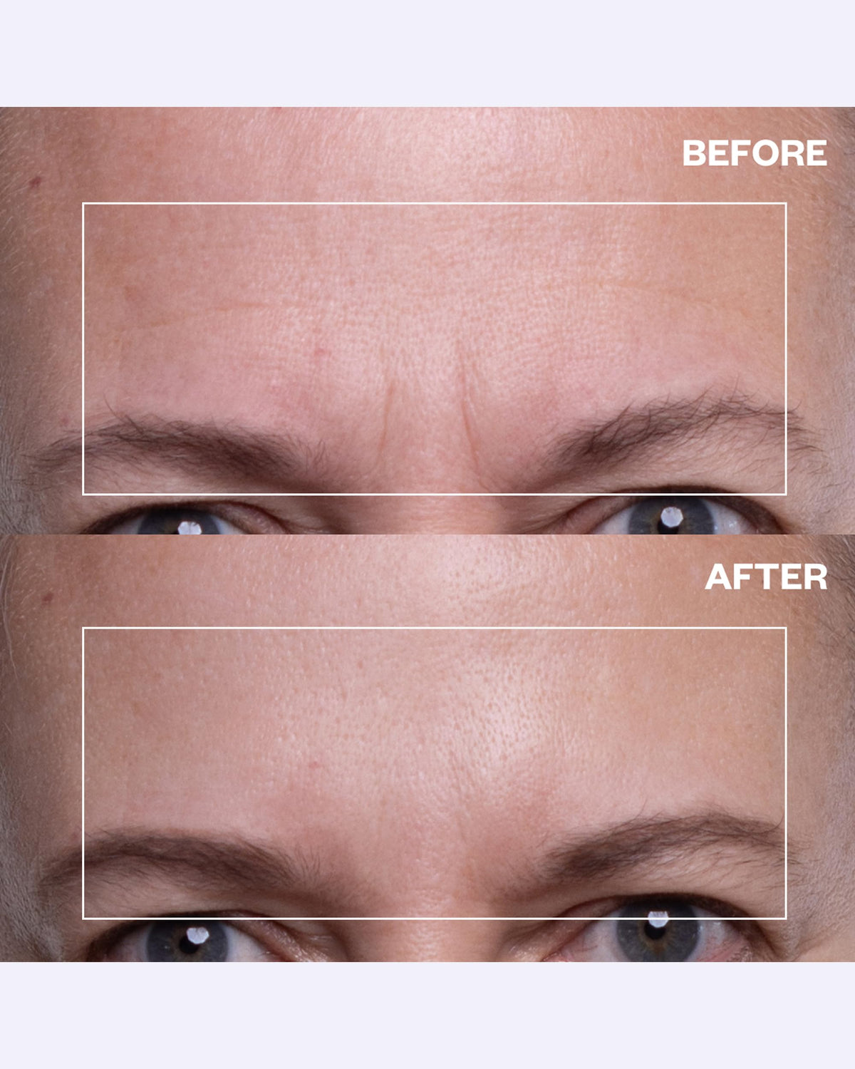 Wrinkles Schminkles forehead patch in use overnight providing gentle refinement.