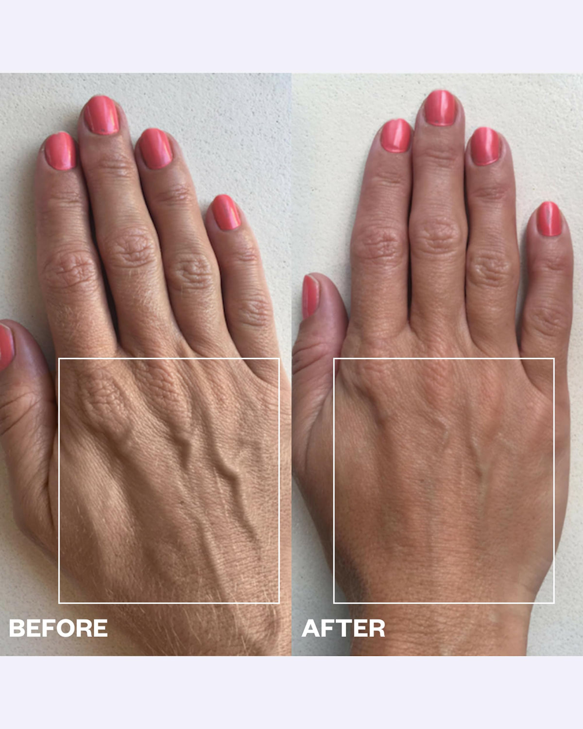 Wrinkles Schminkles overnight patches on skin promote hydration and gentle tightening.