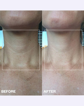 Wrinkles Schminkles patch adhesive side on skin for wrinkle-prevention use