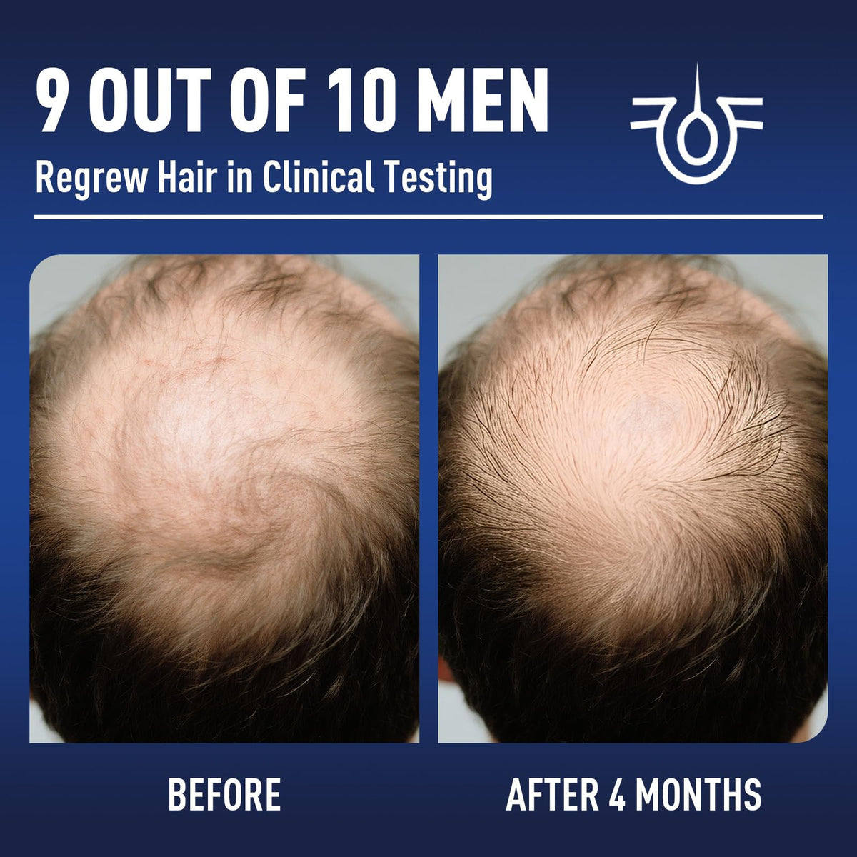 Wuwenbin Minoxidil applied to scalp during use supports fuller-looking hair