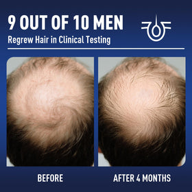 Wuwenbin Minoxidil applied to scalp during use supports fuller-looking hair