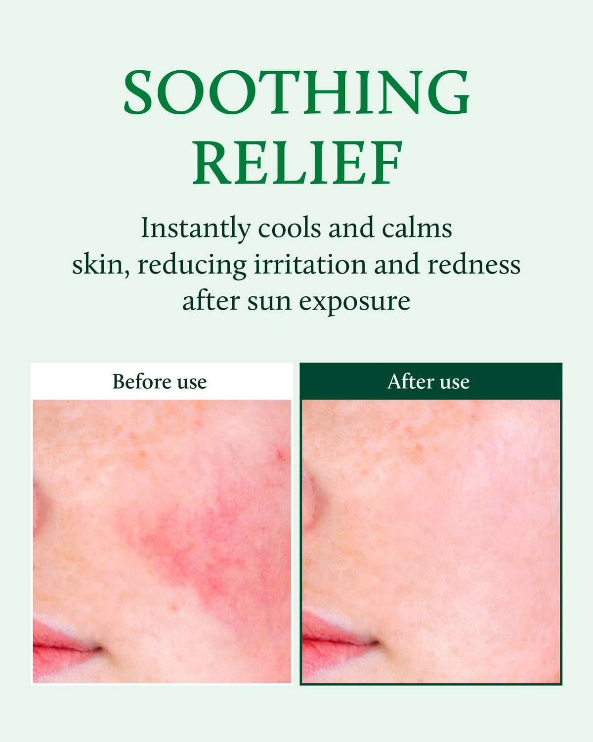 Cooling application demonstrated on irritated skin with YADAH Cactus Soothing Gel