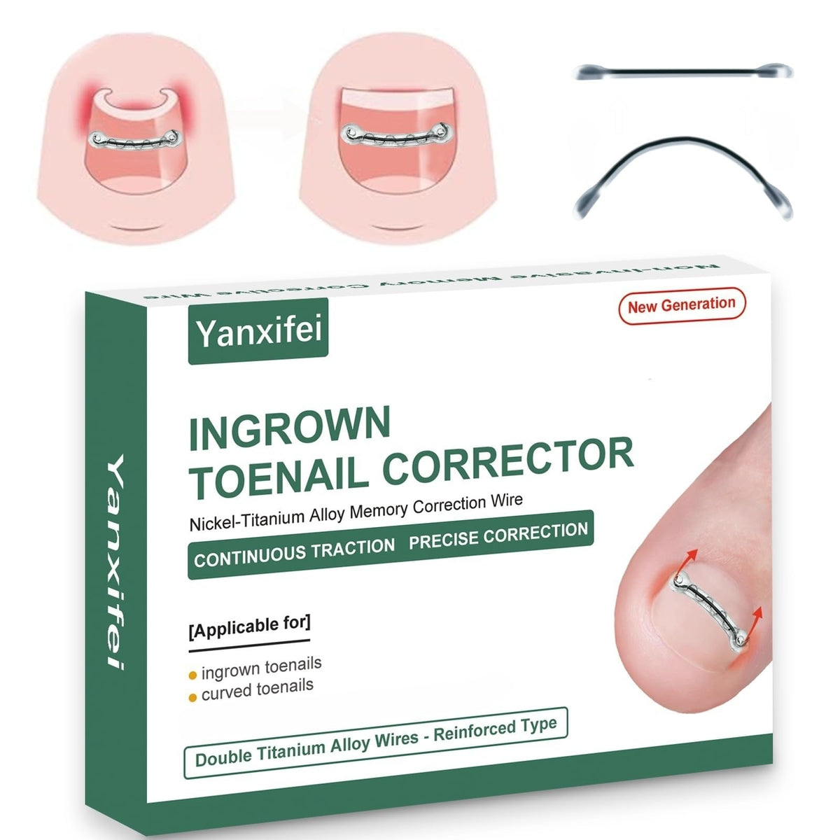 Yanxifei dual nitinol ingrown corrector close-up showing gentle corrective action