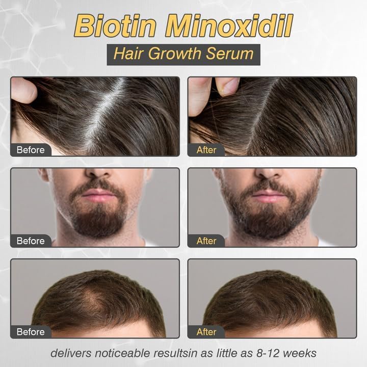 YKDILYHH Minoxidil drops application highlights targeted scalp use