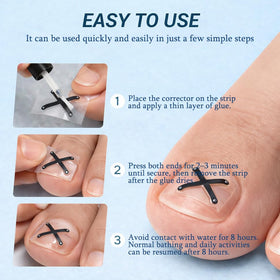 Zinweyton ingrown toenail strips stay secure in wet conditions.