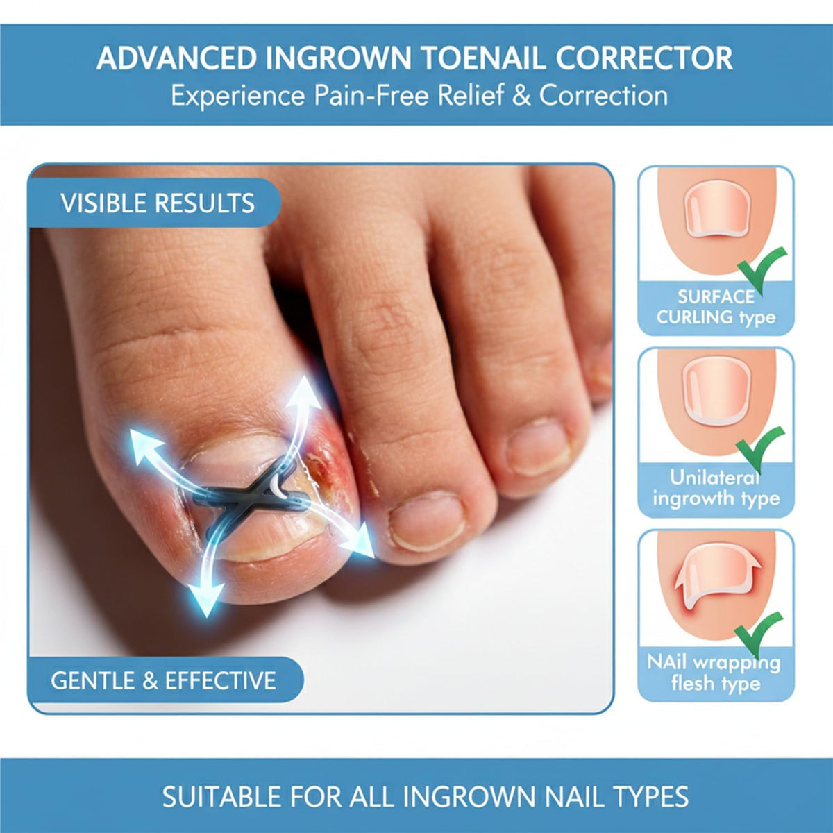 Zinweyton titanium alloy curve corrector flexes 180°, supporting curved nails.