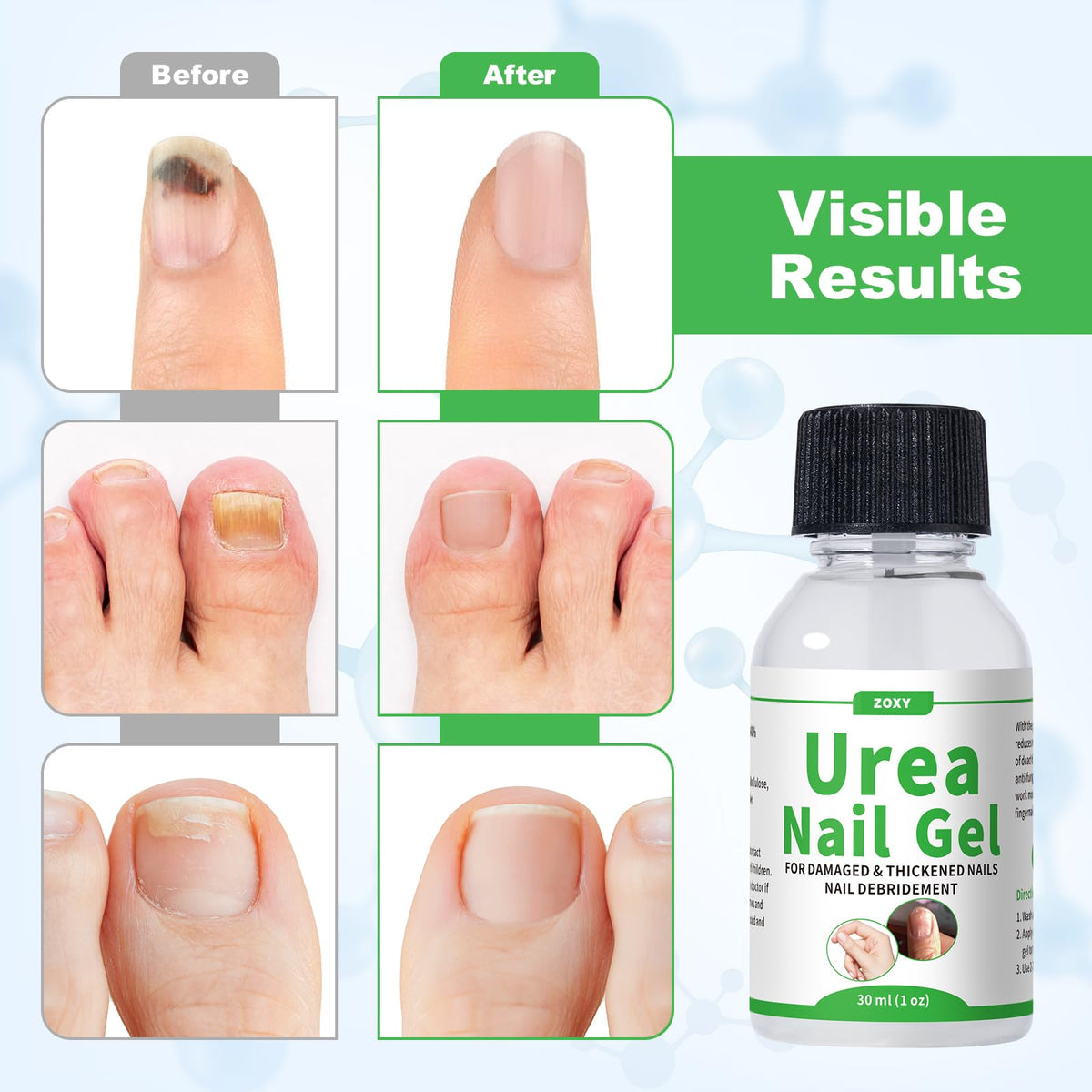 ZOXY Urea Nail Gel packaging highlights a convenient at-home solution.