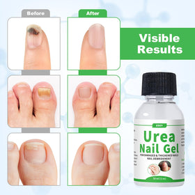 ZOXY Urea Nail Gel packaging highlights a convenient at-home solution.